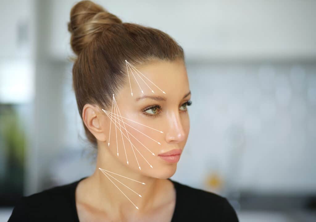 Portfolio 4 Thread Lift ,markup on Young Women Face | Glam Bar Medical Spa in Los Angeles CA