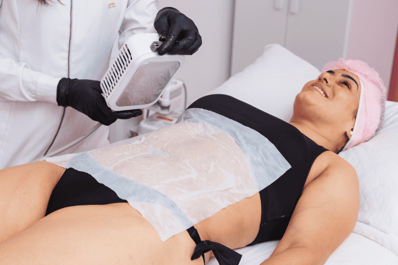 Portfolio 5 Application of cryolipolysis, cryotherapy, preparing to apply to the patient's abdomen, with a single plate of the cryolipolysis device. patient smiling | Glam Bar Medical Spa in Los Angeles CA